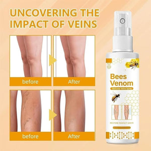 Bee Venon Varicose Veins Spray (Pack of 2)